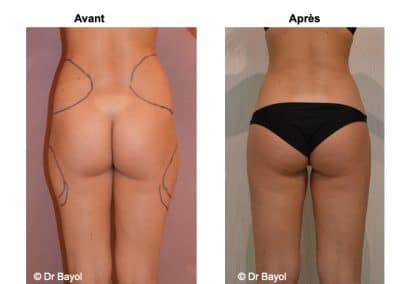 lipoaspiration douce