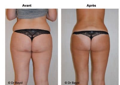 lipoaspiration douce Aix-les-Bains