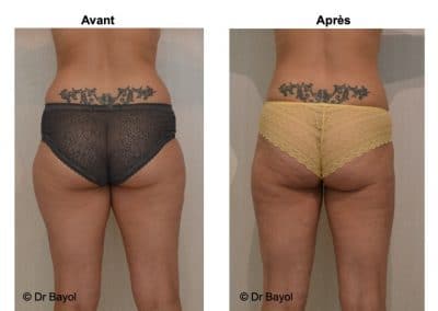 lipoaspiration douce Grenoble