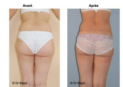 lipoaspiration douce Annecy