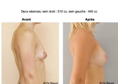 lipofilling des seins Aix-les-Bains