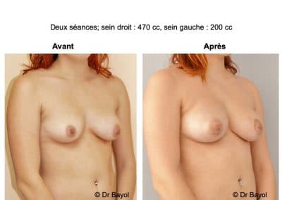 lipofilling des seins Annecy