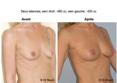 lipofilling des seins Lyon