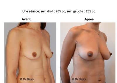 lipofilling seins Aix-les-Bains