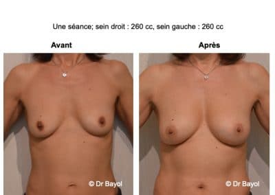 lipofilling seins Lyon