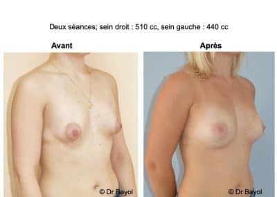 lipostructure des seins Aix-les-Bains