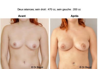 lipostructure des seins Annecy