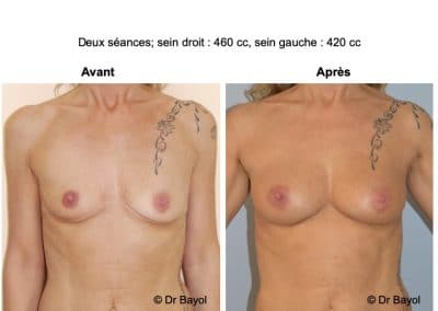 lipostructure des seins Lyon