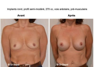 mammoplastie d'augmentation Lyon