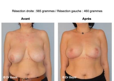 mammoplastie de réduction Aix-les-Bains