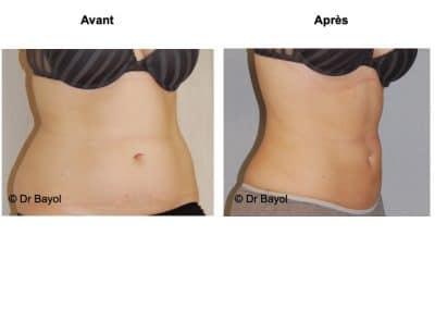 meilleur chirurgien lipoaspiration douce Lyon