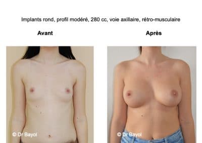 meilleur chirurgien prothèses mammaires Aix-les-Bains