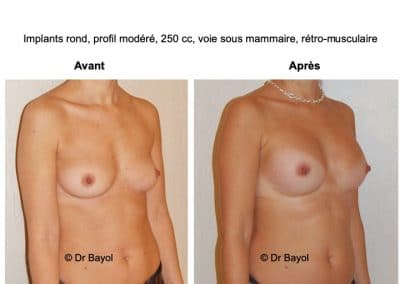 plastie d'augmentation mammaire par implants Lyon