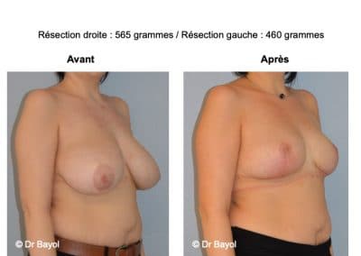 plastie de réduction mammaire Aix-les-Bains