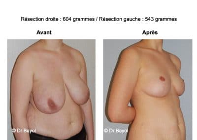 plastie mammaire de réduction Aix-les-Bains