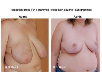plastie mammaire de réduction Genève