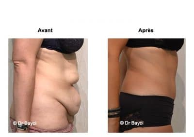 prix abdominoplastie Lyon