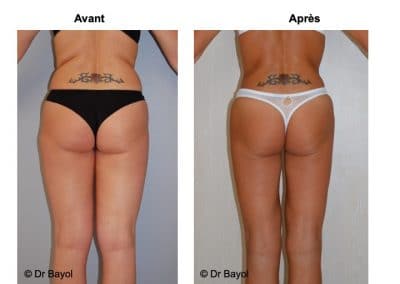 prix lipoaspiration douce Lyon