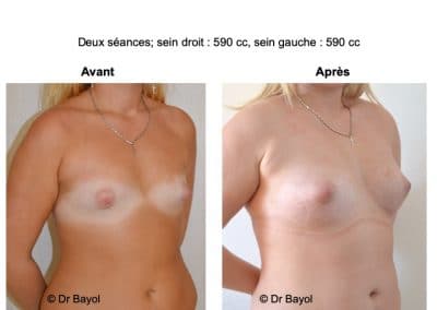 prix lipofilling des seins Lyon