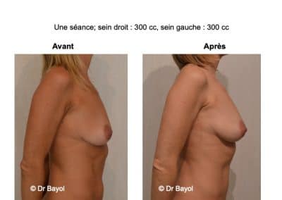 prix lipostructure des seins Lyon