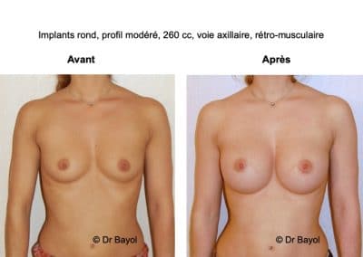 prothèses mammaires Aix-les-Bains
