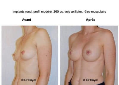 prothèses mammaires Annecy