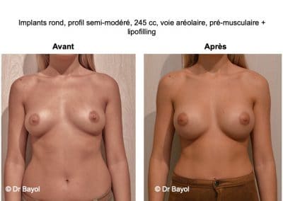 prothèses mammaires Lyon