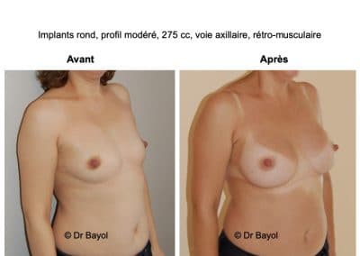 prothèses mammaires à Aix-les-Bains