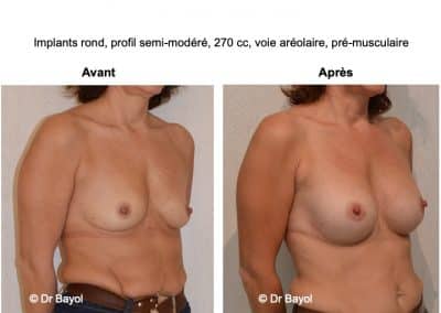 prothèses mammaires à Lyon