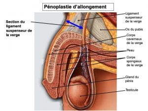 pénoplastie d'allongement Lyon