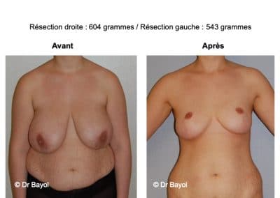 réduction mammaire Aix-les-Bains