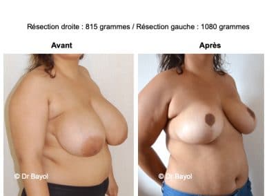 réduction mammaire Annecy