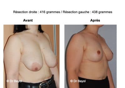 réduction mammaire Lyon
