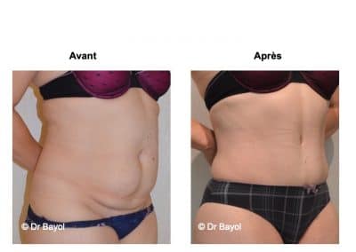 tarif abdominoplastie Lyon