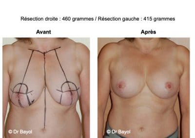 tarif mammoplastie de réduction Lyon