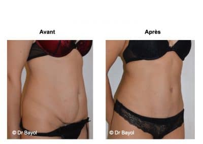 tarifs abdominoplastie Lyon