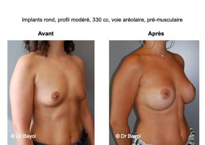 tarifs implants mammaires Lyon