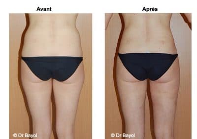 tarifs lipoaspiration douce Lyon