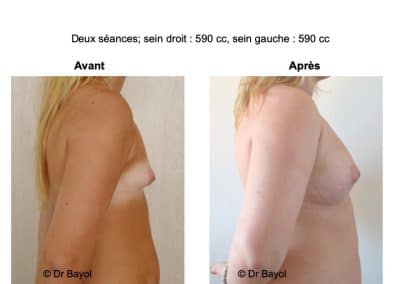 tarifs lipofilling des seins Lyon