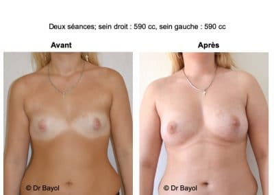 tarifs lipostructure des seins Lyon