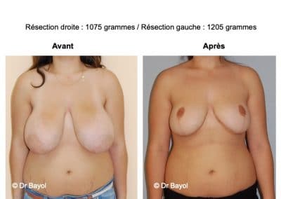 tarifs mammoplastie de réduction Lyon