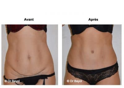 tarifs plastie abdominale Lyon