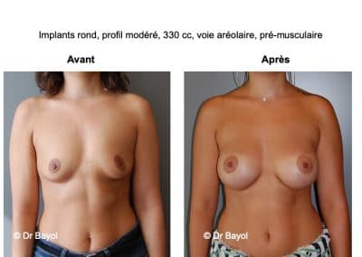 tarifs prothèses mammaires Lyon