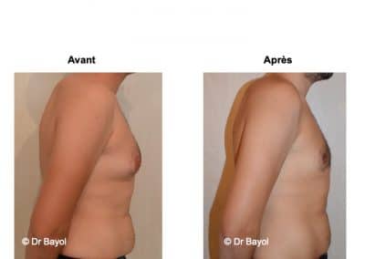 traitement gynecomastie Lyon