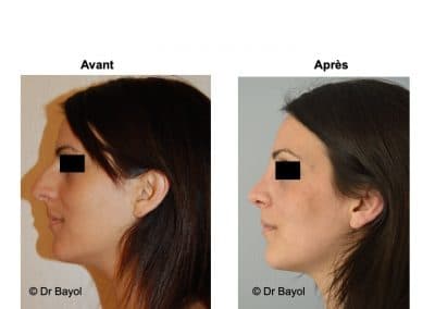 bon chirurgien rhinoplastie Lyon