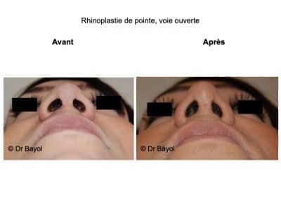 chirurgie esthétique du nez Lyon
