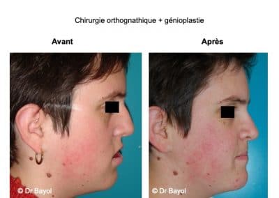 chirurgie orthognatique à Lyon