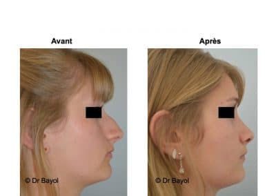 meilleur chirurgien rhinoplastie Lyon