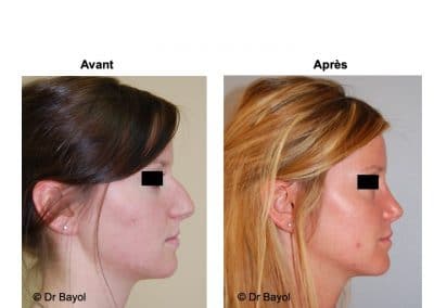 prix rhinoplastie Lyon