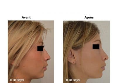 rhinoplastie Aix-les-Bains